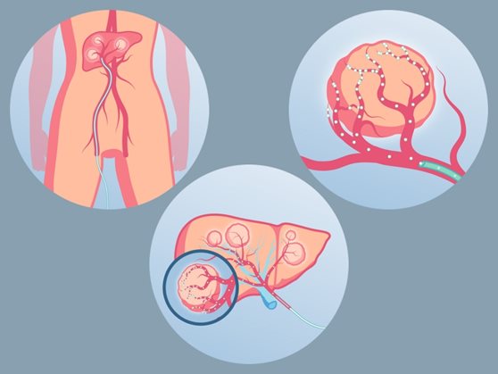 How tiny particles can have a huge impact on liver tumors